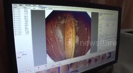Doctors remove 14-centimetre-long toothbrush from Chinese man’s stomach