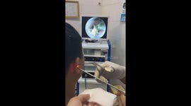 Vietnamese doctor removes butterfly from patient's ear canal