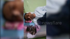 Stunned doctors remove knife, razor blade from man's abdomen who complained of stomach pain in central India