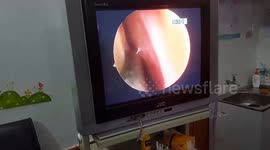 Gruesome moment Vietnamese doctor removes live leech that lived in man’s nose for 11 DAYS