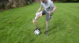 UK teen battling rare bone cancer undergoes rotationplasty surgery so he can play football again