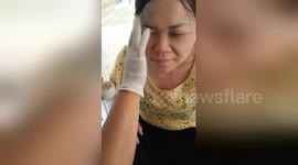 Dozens of parasitic worms removed from Vietnamese woman's face