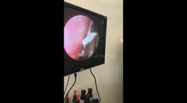 Giant butterfly pulled out of man's ear in surgery clip