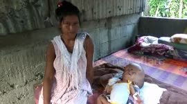 Tragic case of critically ill eight-month-old baby with swollen head in India