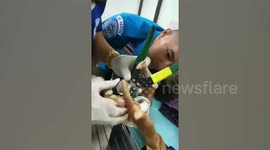 Woman has ring stuck on her finger for 30 years removed in grisly operation