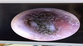Vietnamese doctor finds dozens of mushrooms growing in woman's ears