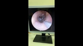 Vietenamese doctor removes mosquito trapped in woman’s ear