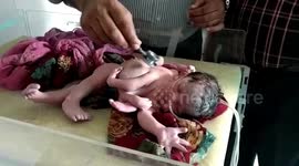 Medical miracle: Baby born with four legs and three hands in India