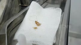 Vietnamese doctor extracts large cockroach from woman's inner ear