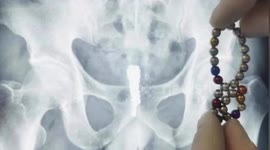 Chinese doctor removes 28 magnetic balls from man's urinary bladder