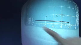 Doctor in China removes needle from boy's abdomen after he swallows it for magic performance