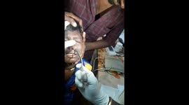 Doctor in India removes live fish from inside 13-year-old boy's nostril
