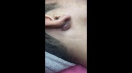 Vietnamese dermatologist removes six-year-old pimple from behind man's ear