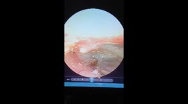 Vietnamese doctor removes live tick from 69-year-old woman's ear