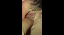popping huge white head and screaming super loud
