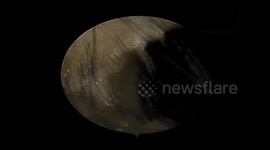 The doctor removed the live leech got into the boy's nose after he bathed in the stream