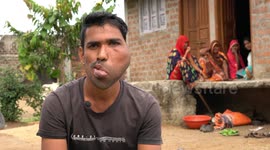 23-year-old man with rare facial disease pleads for funds for life-changing treatment
