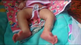 Unique baby born in India with 26 digits on her hands and feet
