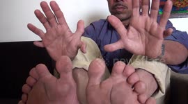 Meet the Indian carpenter who holds the Guinness World Record for most fingers and toes on a living person