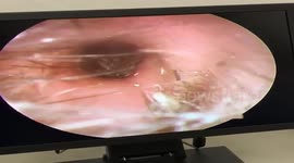 Disturbing video reveals fly burrowing into man's ear with dozens of larvae