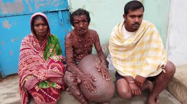 65-year-old Indian pensioner riddled with four stone leg tumour and hundreds more across his body