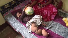 Indian family earning $4-a-day launch plea for baby daughter with condition causing her foot to swell