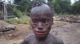 'Human snake': 10-year-old boy in India suffers from rare condition that causes regular skin shedding