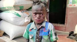 Boy, aged 10, suffering from rare medical condition which affects the development of skin found in eastern India