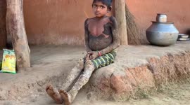 Rare genetic disorder causes girl's skin to turn to 'tree bark' in central India