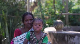 Family earning $70 a month struggles to treat daughter with rare skin condition in east India