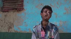 35-year-old man suffering from rare medical condition has his face engulfed with 'heavy tumours' in eastern India
