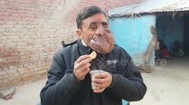 Indian priest worshipped as a god due to massive facial tumour says he's nearly ‘exhausted savings' in search for cure