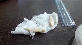 Indian dentist claims he removed the longest ever teeth from patient