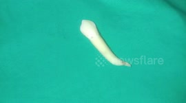 Man believed to hold the record for world's largest tooth has it removed