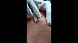 The dermatologist remove 8-year-old giant pimple on the back of the man