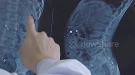 Doctor in China removes toothpicks, cotton swabs and pencils from boy's body