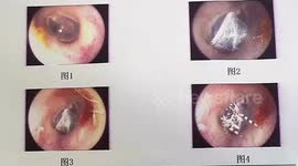 Chinese doctor removes spider that was weaving webs in woman's ear