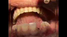 Oddly satisfying footage of dental implants in Turkey