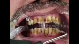 Satisfying and disgusting video of dental cleaning