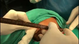 Indian doctors remove iron hook gruesomely embedded in young boy's throat