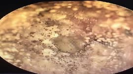 Doctor in Vietnam removes 'thousands of mushrooms' from man's ear