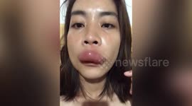 Woman's lip swells up like a 'sausage' after bee sting