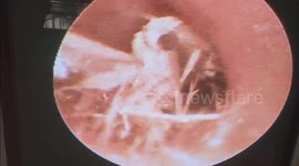 Doctor removes living butterfly from man's ear in Vietnam