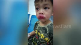 Chinese boy’s lips swell massively after allergic reaction grapes