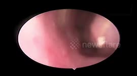 Doctor removes 15cm living leech that was sucking blood from inside the walls of a woman's nose