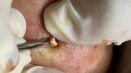 Dermatologist removes large pimple from Vietnamese man's cheek