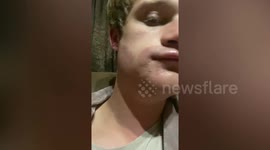 Man suffers shocking allergic reaction on his face after attempting to dye his beard purple whilst bored in lockdown