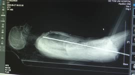 Doctor removes 80-centimetre-long rebar from woman's body in China