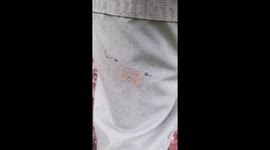 'Tick bomb' sees hundreds of baby insects crawl on Missouri man's leg