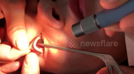 The doctor removes the living leech in the woman's eye